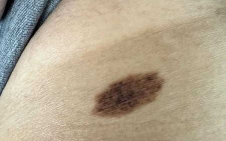 Ich habe diesen Maulwurf mit fleckigen dunklen Flecken. Was soll ich tun?