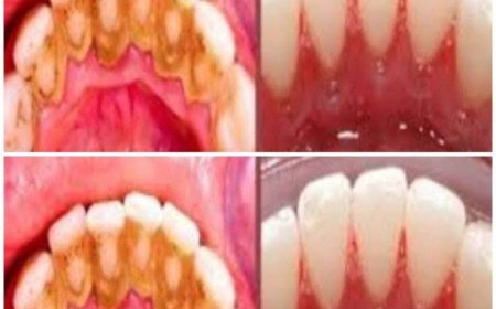 Zahnbelag selbst entfernen: Schnelles und einfaches Hausmittel