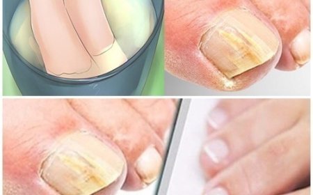 Nagelpilz mit diesen Hausmitteln beseitigen