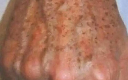 Warum bilden sich Flecken auf den Händen und wie kann man sie entfernen?