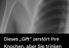 Dieses „Gift“ schädigt Ihre Knochen – und Sie trinken es jeden Tag