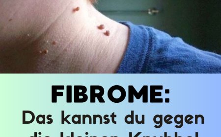 Fibrome: Das kannst du gegen die kleinen Knubbel auf der Haut tun
