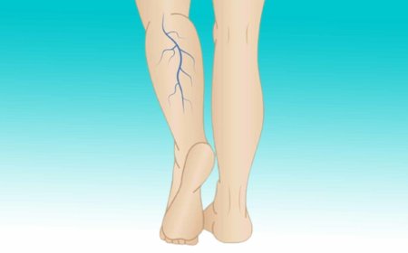 Wenn Sie violette Adern an den Beinen haben, bedeutet das, dass Sie…