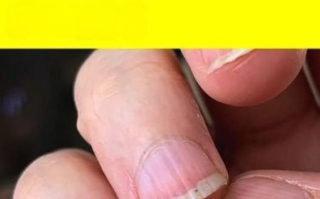 Geriffelte Nägel: Ursachen, Bedeutung und natürliche Lösungen