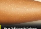 Weiße Flecken auf der Haut: Welche Vitaminmängel könnten die Ursache sein