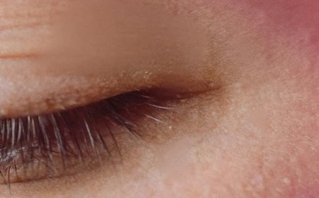 Milien Im Gesicht: Ursachen, Pflege Und Hilfreiche Tipps